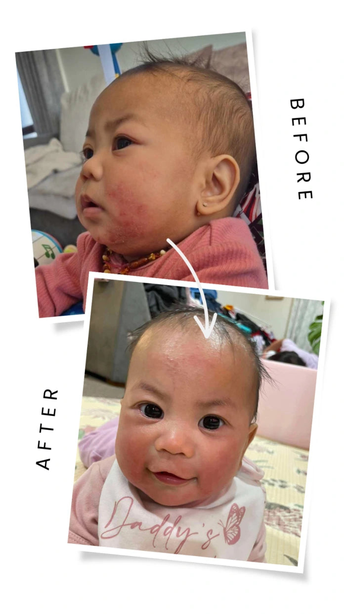 baby eczema