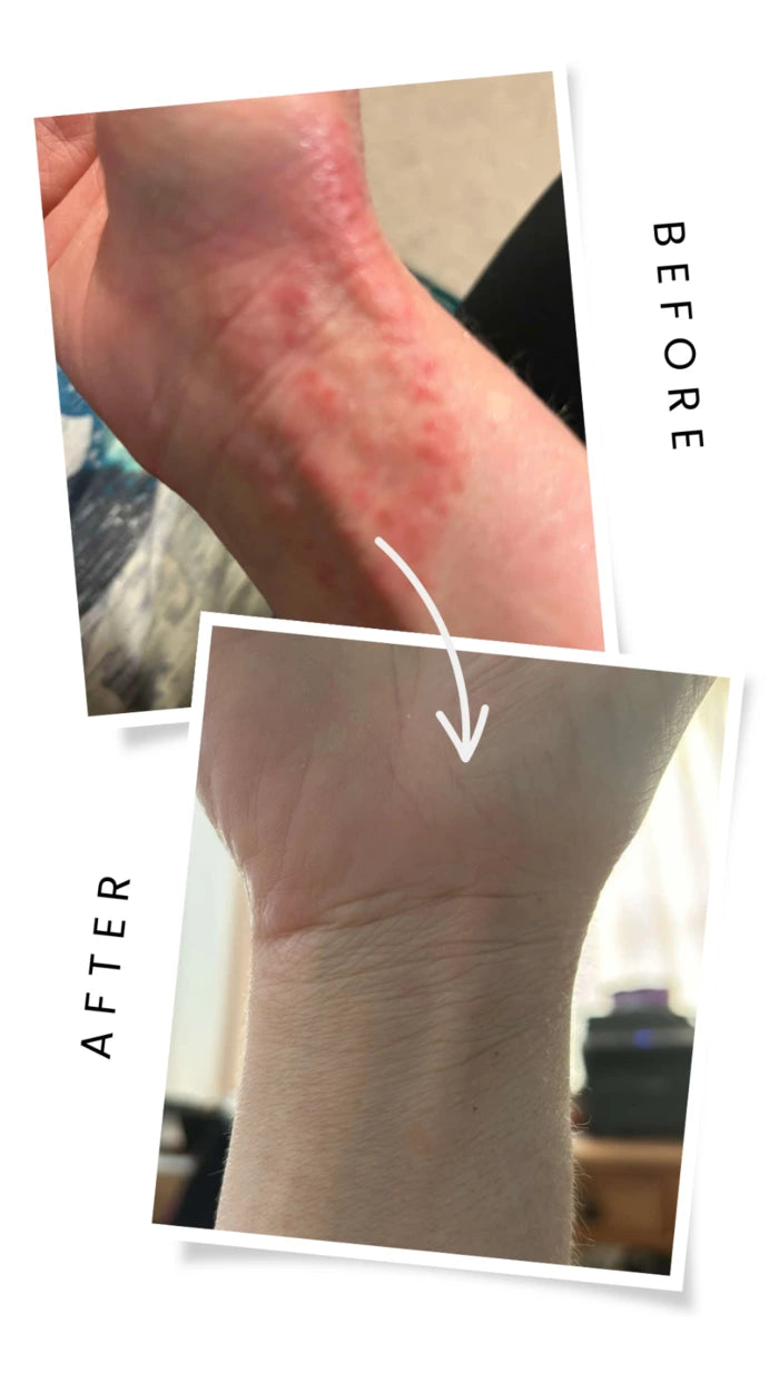 eczema