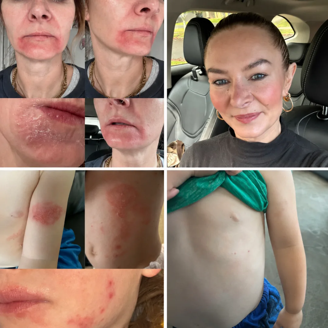 Tallow balm NZ — before and after on dry, irritated skin