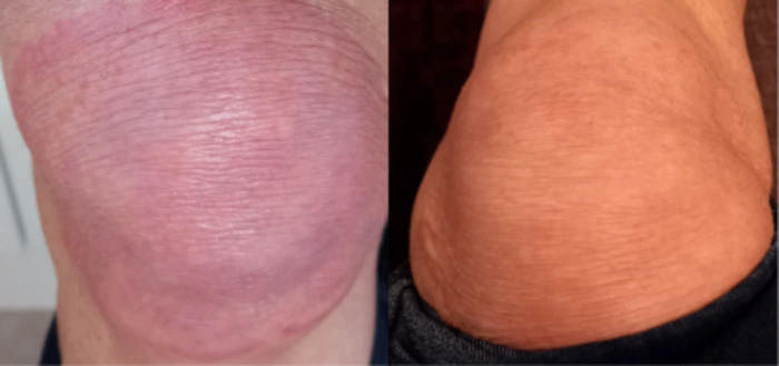 Tallow balm NZ eczema before and after